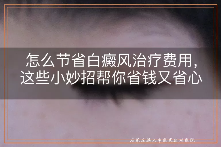 怎么节省白癜风治疗费用，这些小妙招帮你省钱又省心！