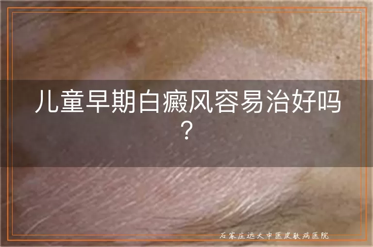 儿童早期白癜风容易治好吗？