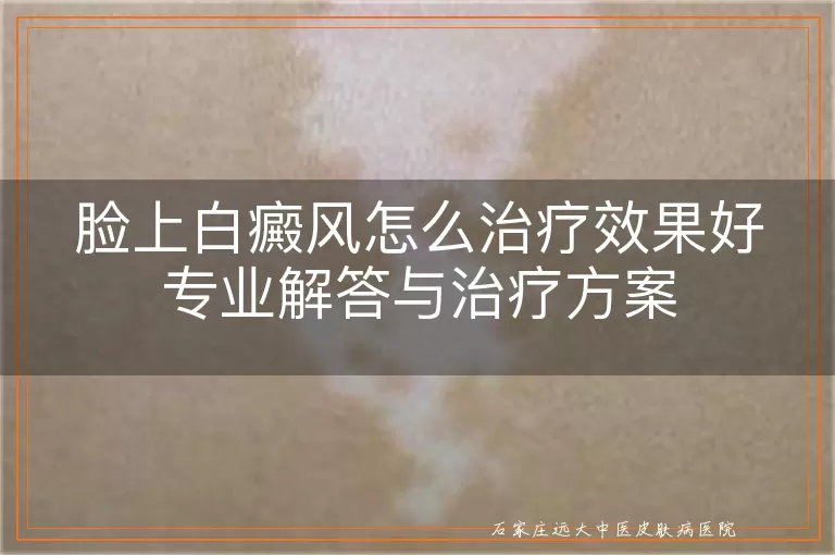 脸上白癜风怎么治疗效果好专业解答与治疗方案