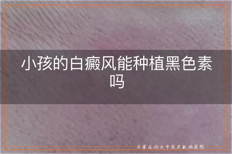 小孩的白癜风能种植黑色素吗