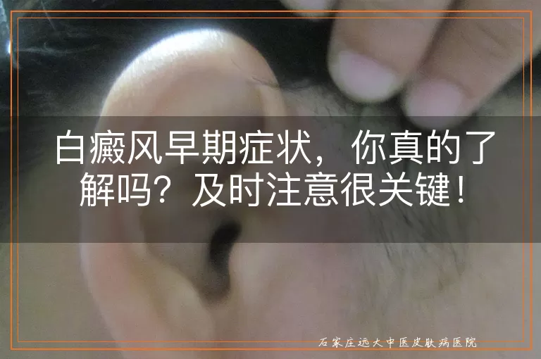 白癜风早期症状，你真的了解吗？及时注意很关键！