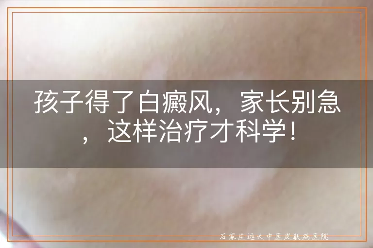 孩子得了白癜风，家长别急，这样治疗才科学！
