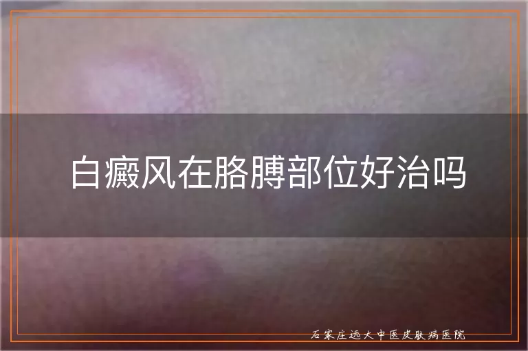 白癜风在胳膊部位好治吗
