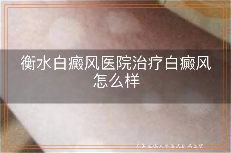 衡水白癜风医院治疗白癜风怎么样