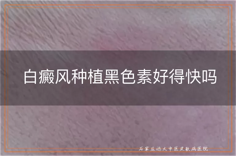 白癜风种植黑色素好得快吗