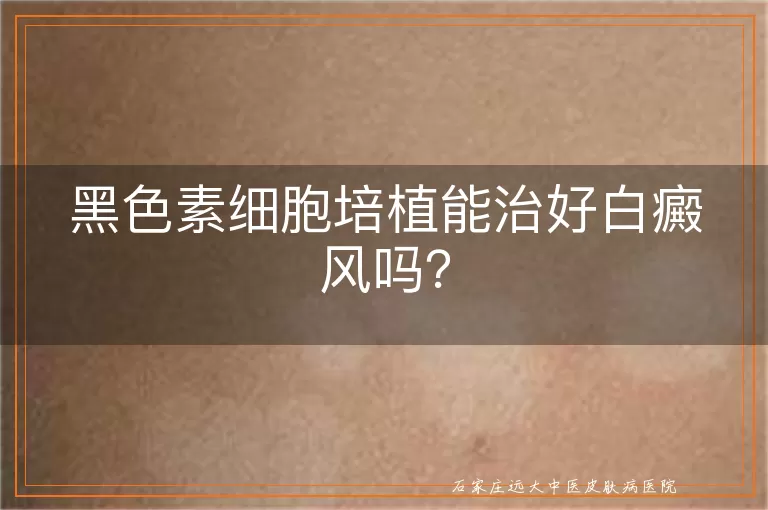 黑色素细胞培植能治好白癜风吗？