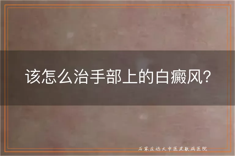 该怎么治手部上的白癜风？