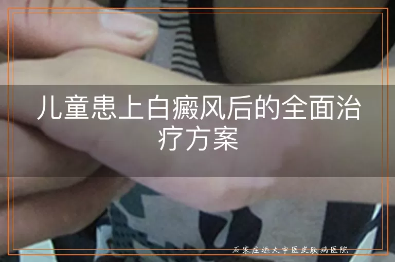 儿童患上白癜风后的全面治疗方案