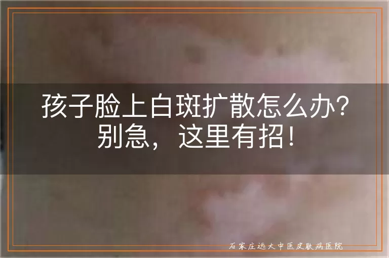 孩子脸上白斑扩散怎么办？别急，这里有招！