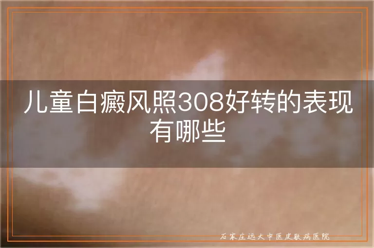 儿童白癜风照308好转的表现有哪些