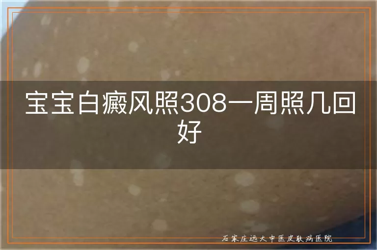 宝宝白癜风照308一周照几回好