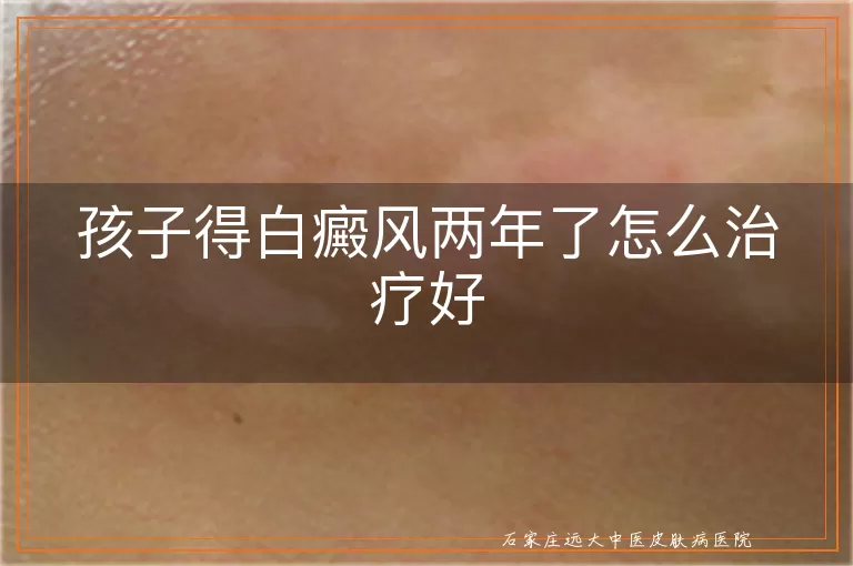 孩子得白癜风两年了怎么治疗好