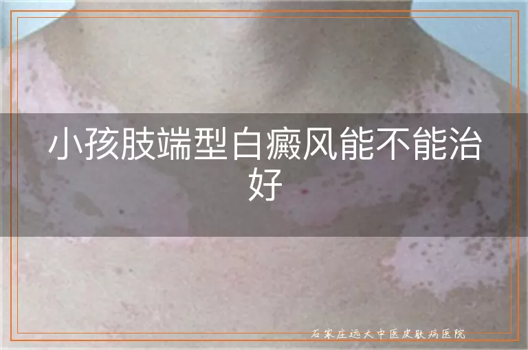 小孩肢端型白癜风能不能治好