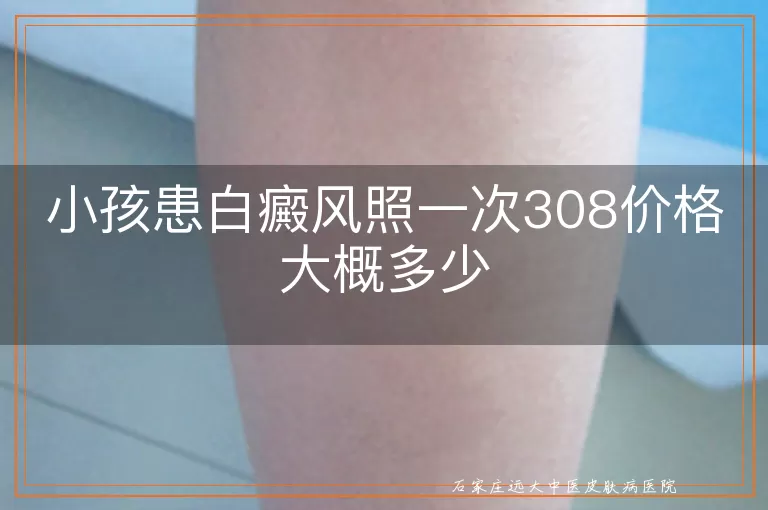 小孩患白癜风照一次308价格大概多少