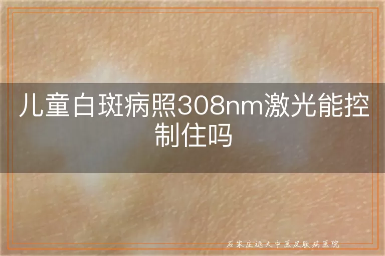 儿童白斑病照308nm激光能控制住吗