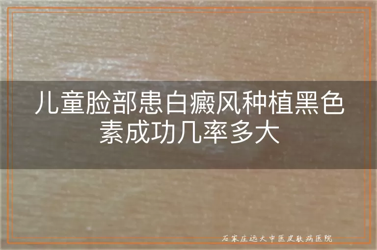 儿童脸部患白癜风种植黑色素成功几率多大