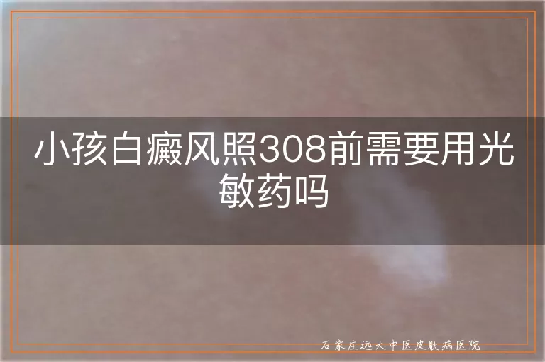 小孩白癜风照308前需要用光敏药吗