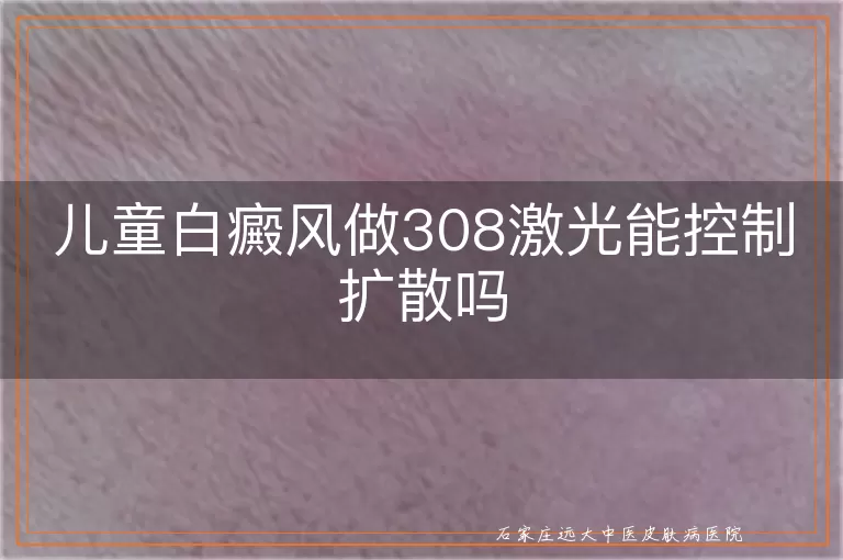 儿童白癜风做308激光能控制扩散吗