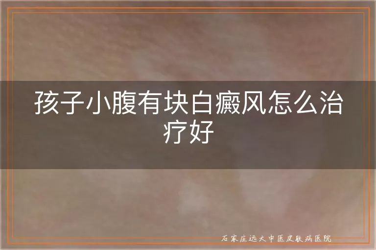 孩子小腹有块白癜风怎么治疗好