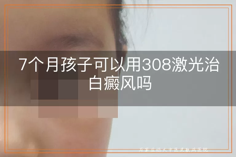 7个月孩子可以用308激光治白癜风吗