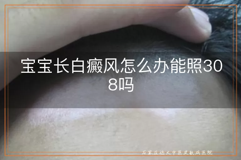 宝宝长白癜风怎么办能照308吗