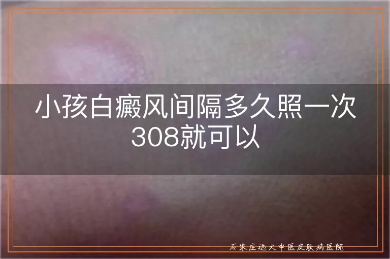 小孩白癜风间隔多久照一次308就可以