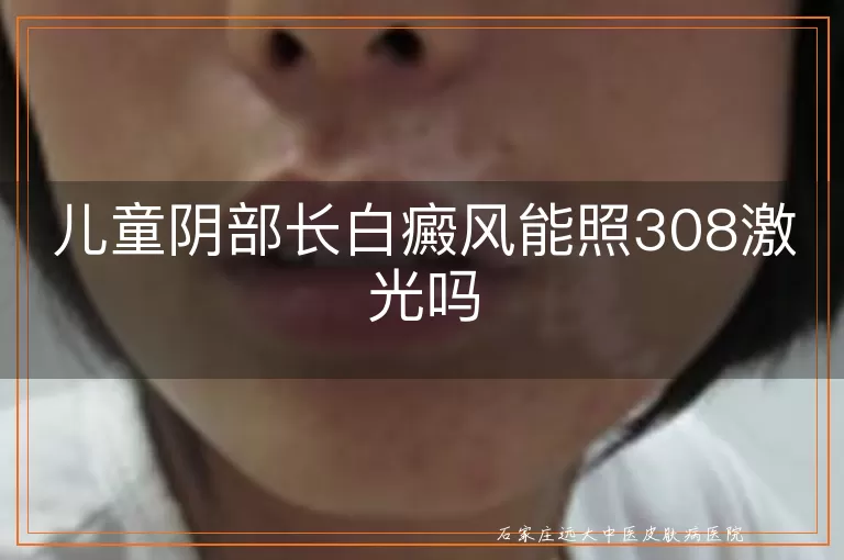 儿童阴部长白癜风能照308激光吗