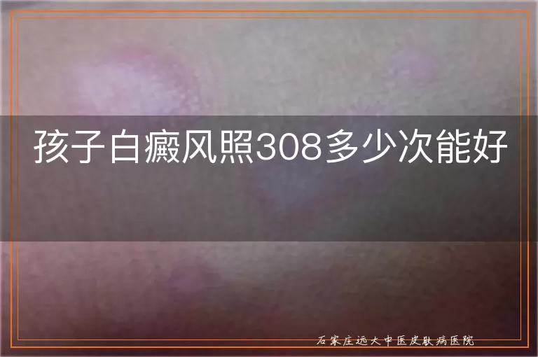 孩子白癜风照308多少次能好