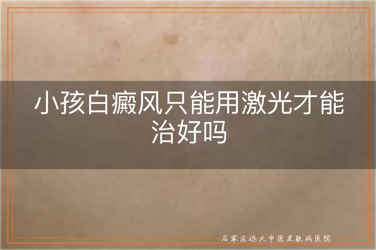 小孩白癜风只能用激光才能治好吗