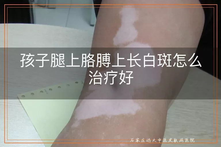 孩子腿上胳膊上长白斑怎么治疗好