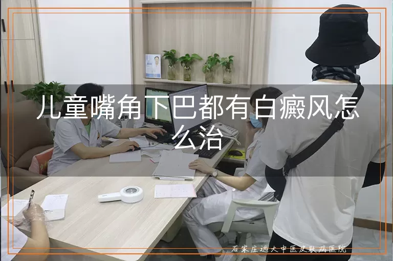 儿童嘴角下巴都有白癜风怎么治