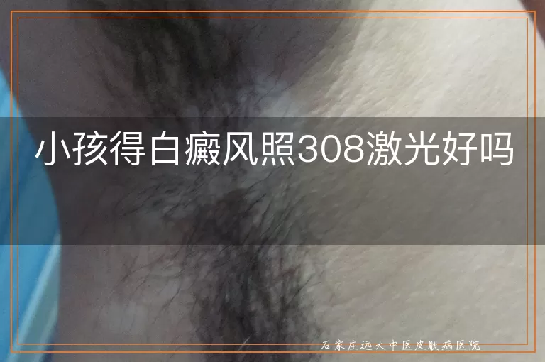小孩得白癜风照308激光好吗
