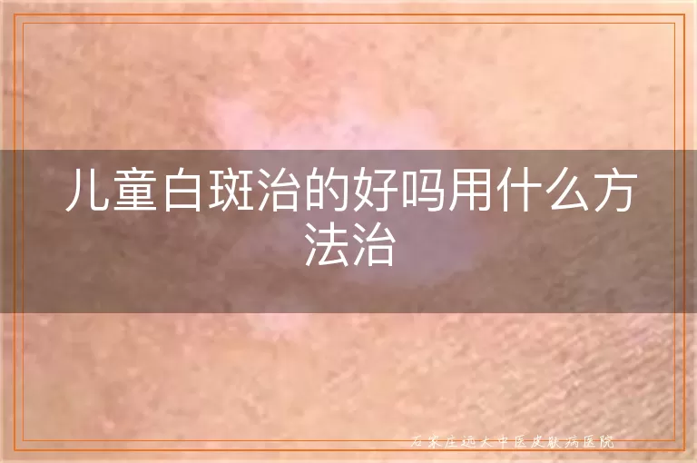 儿童白斑治的好吗用什么方法治