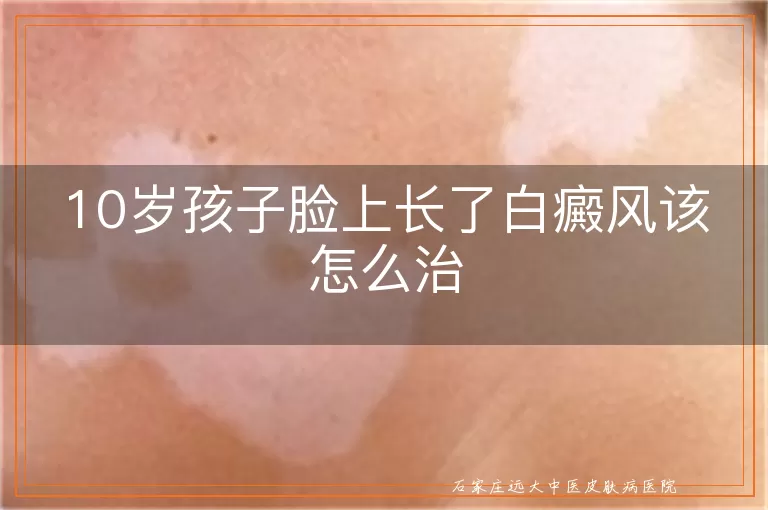 10岁孩子脸上长了白癜风该怎么治