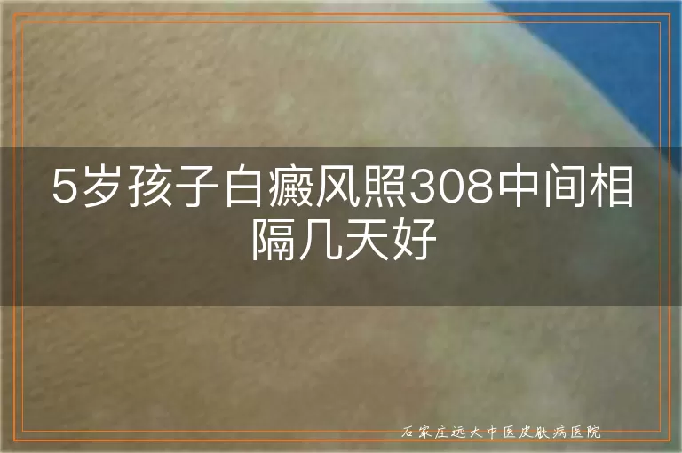 5岁孩子白癜风照308中间相隔几天好
