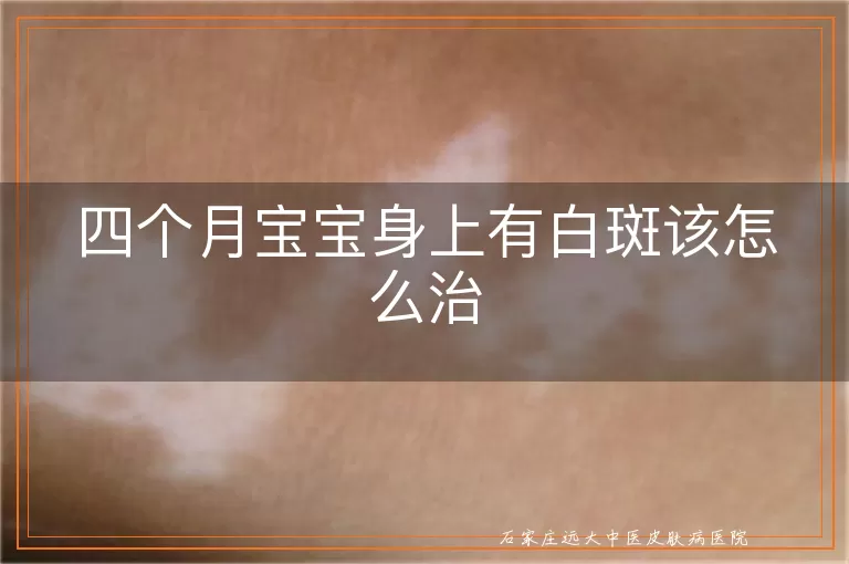 四个月宝宝身上有白斑该怎么治