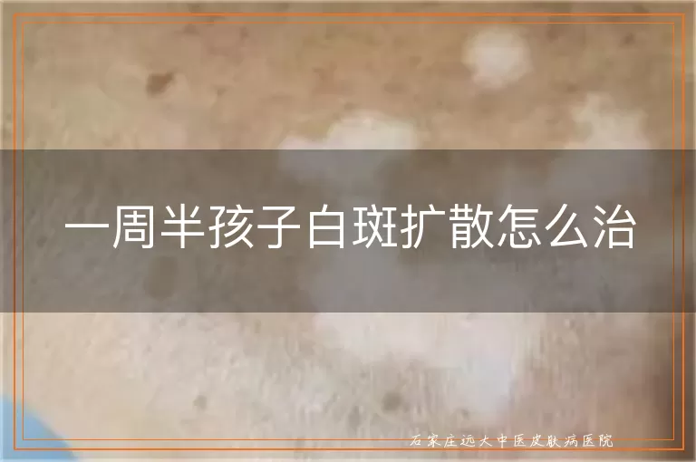 一周半孩子白斑扩散怎么治