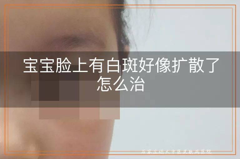 宝宝脸上有白斑好像扩散了怎么治