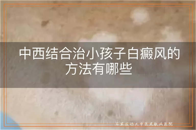 中西结合治小孩子白癜风的方法有哪些