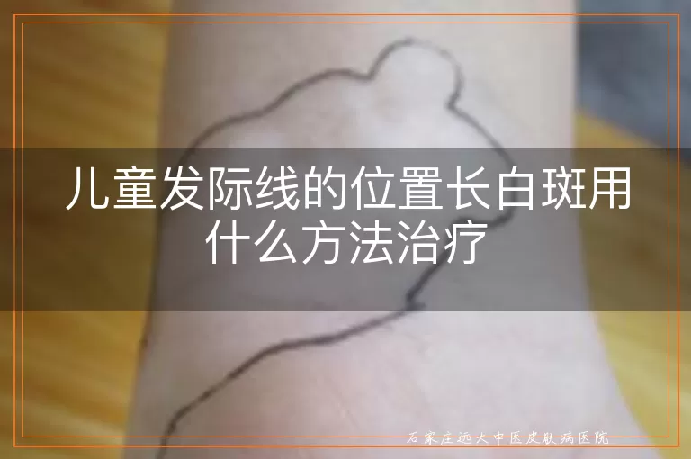 儿童发际线的位置长白斑用什么方法治疗