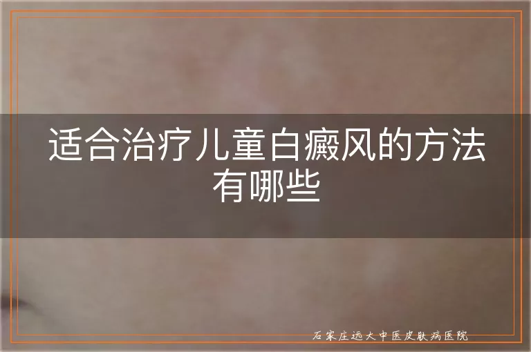 适合治疗儿童白癜风的方法有哪些