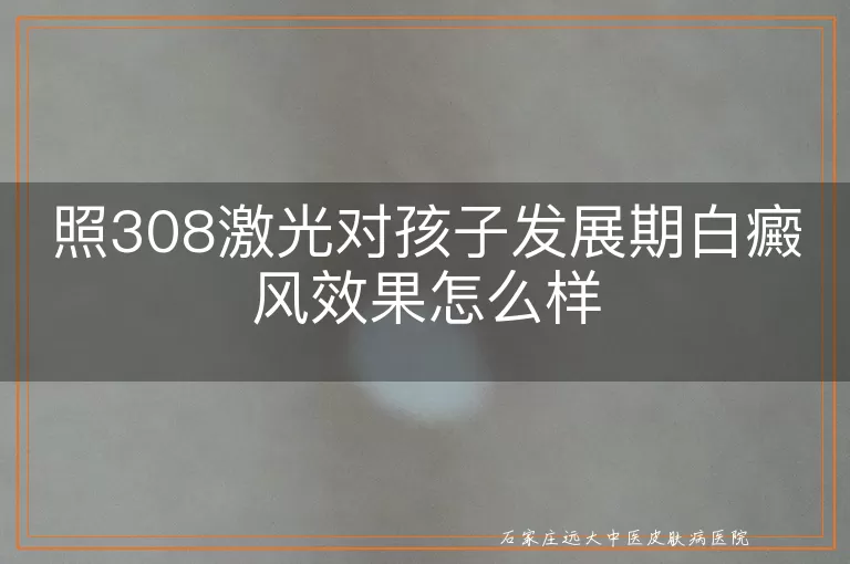 照308激光对孩子发展期白癜风效果怎么样