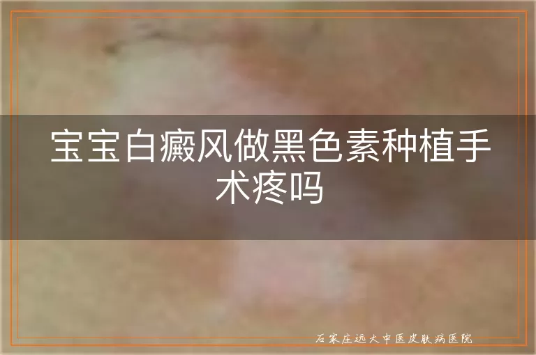宝宝白癜风做黑色素种植手术疼吗