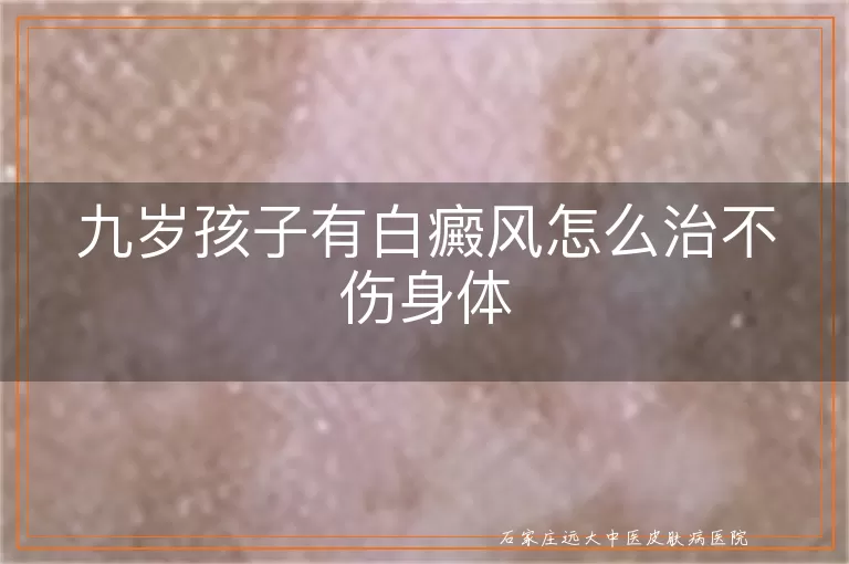 九岁孩子有白癜风怎么治不伤身体