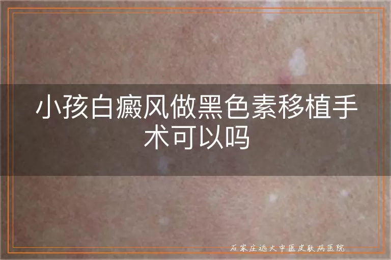 小孩白癜风做黑色素移植手术可以吗