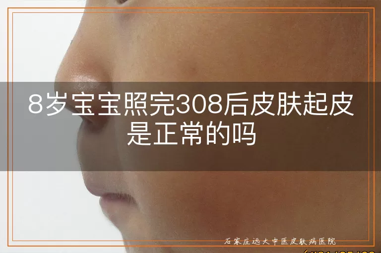 8岁宝宝照完308后皮肤起皮是正常的吗