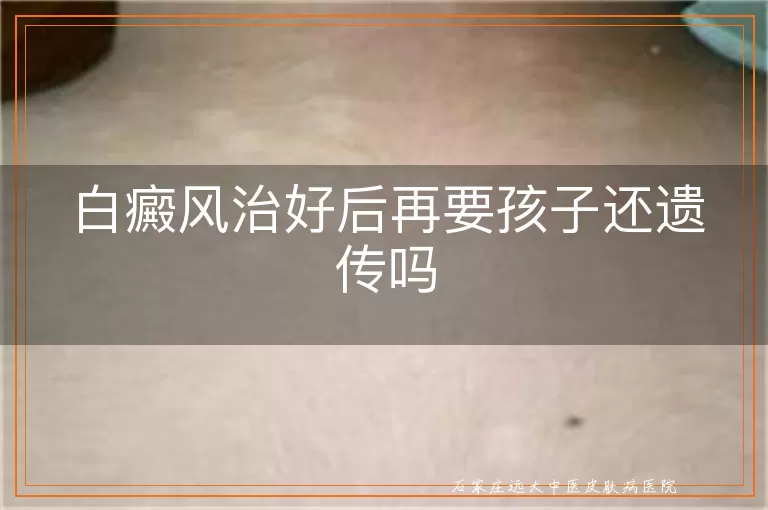 白癜风治好后再要孩子还遗传吗