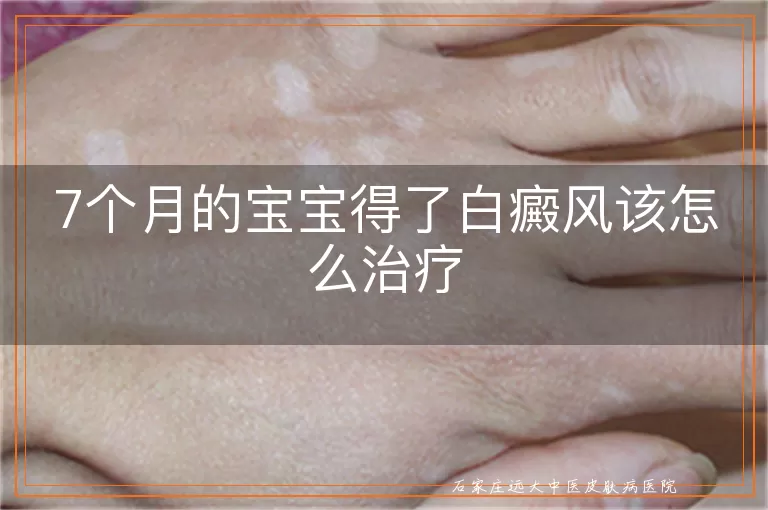 7个月的宝宝得了白癜风该怎么治疗