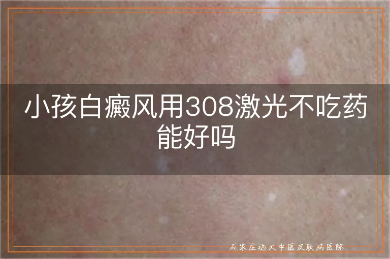 小孩白癜风用308激光不吃药能好吗