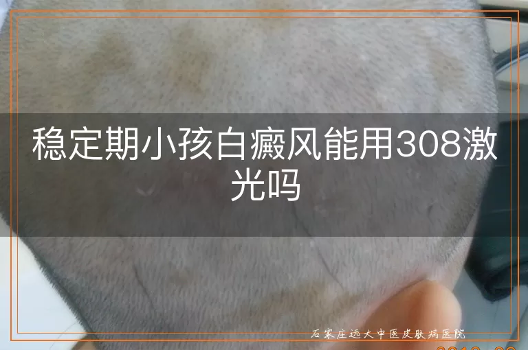 稳定期小孩白癜风能用308激光吗
